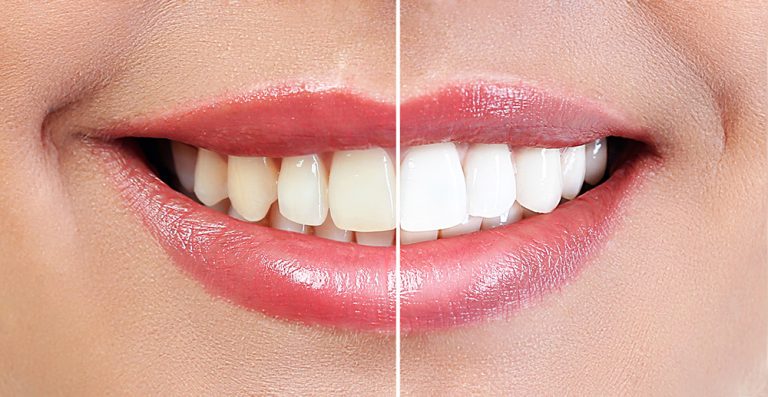 Professional Teeth Whitening in Round Rock - Teeth Whitening Dentist