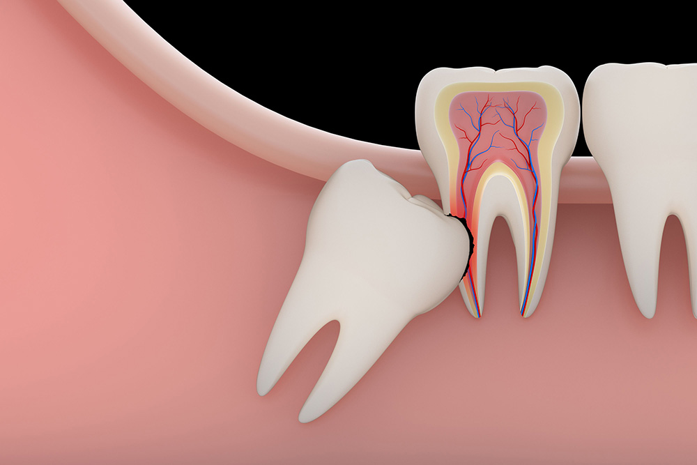 Wisdom Teeth Removal Near Me Medicaid