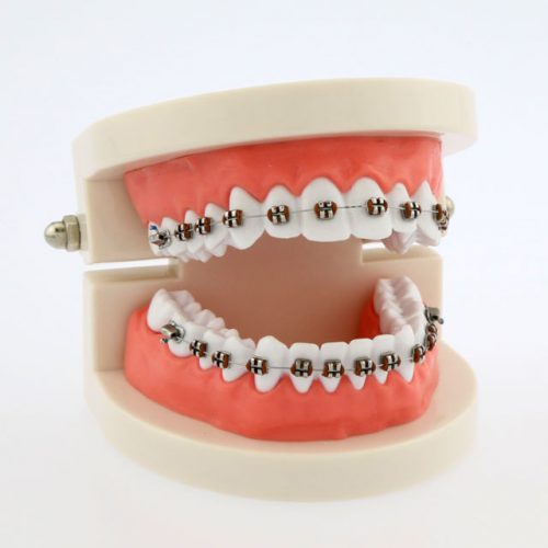 Ceramic Braces: Ancient Origins, Bright Future! - Sunbury Dental House